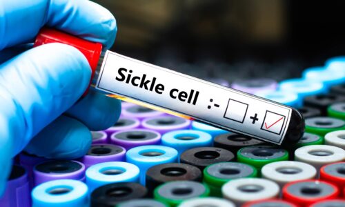 New sickle cell gene therapies are a breakthrough, but solving how to pay their high prices is a struggle